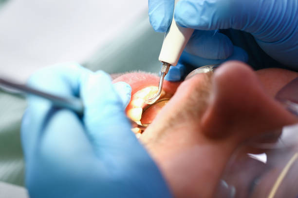 Best Emergency Dentist for Knocked-Out Tooth in Northville, NY